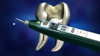 Root Canal Filling Procedure 5min  wmv HD