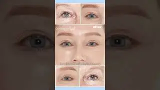 Best results of Anti-aging eye plastic surgery in Korea ✨