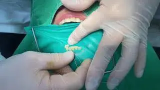 20240813 rubberdam isolation of lower anterior teeth