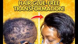 hairloss method
