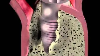 Guided Tissue Regeneration (Implant)