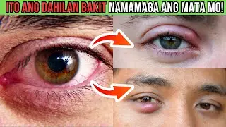 TOP 9 SANHI at DAHILAN ng PAMAMAGA ng MATA!