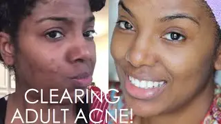 CLEARING MY ADULT ACNE + SKIN CARE ROUTINE | beauty