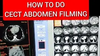 CECT Whole Abdomen Filming Protocol.