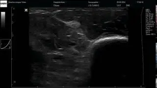 msk SonoFly&reg;MS hand flexor pollicis longus 2