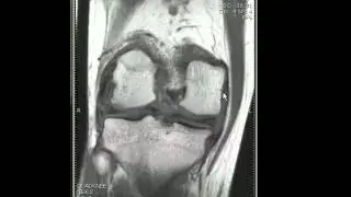 Musculoskeletal MR - Knee