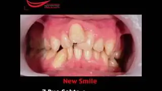 Orthodontie avant - apr&egrave;s par New Smile Casablanca