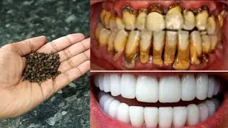 MAGICAL TEETH WHITENING REMEDY | NATURAL HOME REMEDY | Mr. Maker