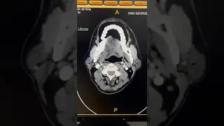 Unveiling TONGUE Cancer: The CT Scan Secrets! #shorts