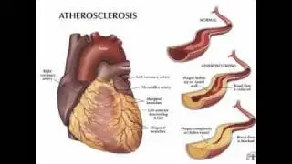 The Truth about Statins, Cholesterol and Heart Disease - part 1