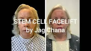 Plastic Surgery London - Stem Cell Facelift Surgery