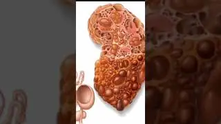 what is kidney cyst and it's types