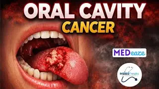 ORAL CAVITY CANCER PART-1 | HEAD AND NECK SURGERY | MBBS FREAKS 