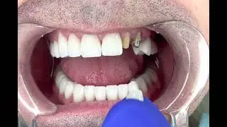 HOLLYWOOD SMILE-in process
