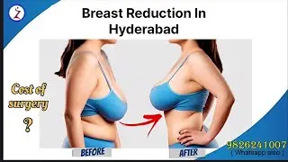 Breast Reduction in Hyderabad | Breast Reduction Surgery in Hyderabad at Zenith Clinic