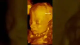 3D/4D Photo Dump 18 #ultrasound #3dultrasound #4dultrasound #sonography #3dsonography #4dsonography