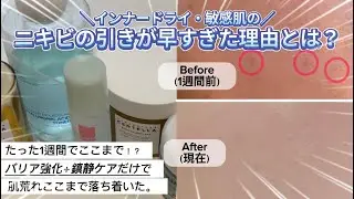 【1週間でニキビ改善】肌荒れループから、バリア強化×鎮静だけでここまで改善！