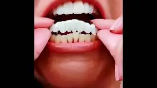 Snap On Smile Veneers Teeth For Men And Women Moldable False Artificial Braces Teeth Kits*
