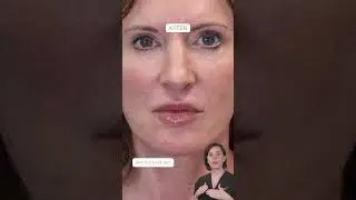 Sculptra, PDO Threads, and Lip Filler: Before & After