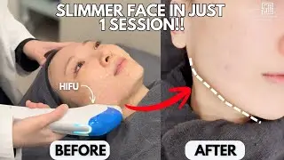 Korea&rsquo;s Glass Skin Secret 😱 | HIFU Lift + LHA Peel (No Surgery, No Downtime)