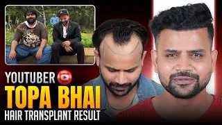 Youtuber Nadeem Bunny (Topa Bhai)15 Months Result Update | Grade 3 Hair Transplant | QHT | 2026 #qht