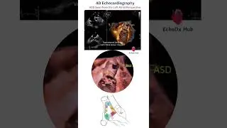 4D Echocardiography: ASD Seen from the Left Atrial Perspective  #echocardiography