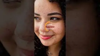 ✨Laser Freckle Removal💥@DermaVue #freckles #freckle #frecklestreatment