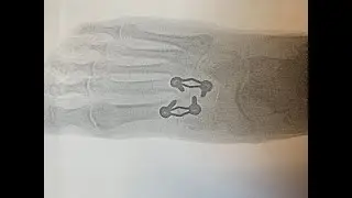 anxieties & fears of getting midfoot fusion