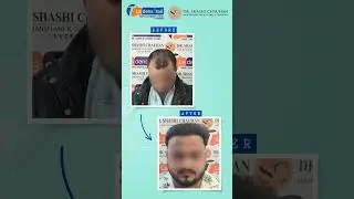 Best Hair Transplant Results | Before After | Dr. Shashi Chauhan