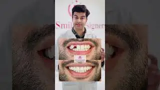 Dental implant | Implant treatment | best dentist in Chandigarh | #thesmiledesigners #dentalimplants