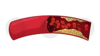 Cholesterol plaque obstructing blood flow cartoon animation