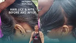 Lice And Nits Treatment in Our Service 💯 Before And After |#headlicetreatment  #lice #nits #hair #yt