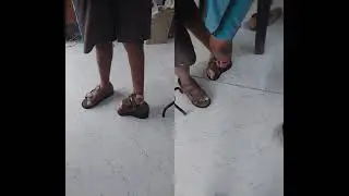 Moulded Footwear for physically handicapped (polio adult clubfoot twisted feet) My Care Prosthetics