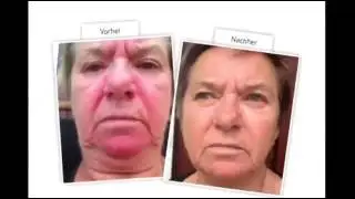 ASEA Renu28  Результаты после 28 дней применения RENU 28