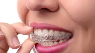FAQ - What is a Six Month Smile? | 21st Century Dental | Cosmetic Dentist Irving