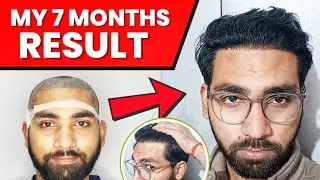 My 7 Month's Hair Transplant Result 🔥🔥🔥 Hair Transplant Cost In India 