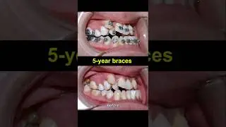 Crooked teeth braces, 5 years duation #braces #dentist #orthodontist