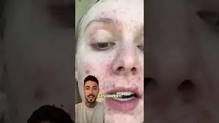 Пилинг от акне #WW139077 WB от Cosmeya #скинке #acnecare #glowup #чистаякожа