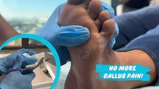 Облегчение боли в мозолях: проверенные советы и рекомендации | MediPedi Spa