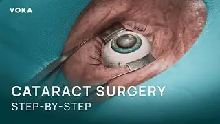 Cataract Surgery Explained in 3D: Phacoemulsification Step-by-Step