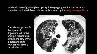 Radiology of diffuse lung disease - 5