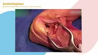 Radial Head Replacement Surgical Procedure, Technique, and Tips and Pearls from a Surgeon
