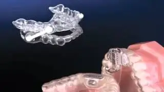 AveoTSD tongstabilisator