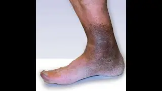 Venous Insufficiency PT License Preparation No 9