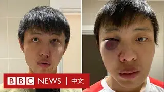 新冠肺炎：亞裔留學生受歧視 倫敦街頭被毆打－ BBC News 中文