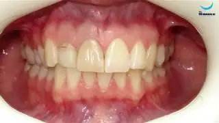 Скученность зубов. Догару А. М. Клиника Dr. Smile
