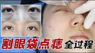 割眼袋、点痣全记录！鬼知道我经历了什么？！