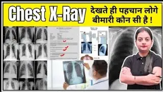 Chest X Ray | X Ray | X Ray Reading in hindi |Pneumonia | Lungs Effusion | X-Ray Kaise HotaHai ✅✅💯💯💯