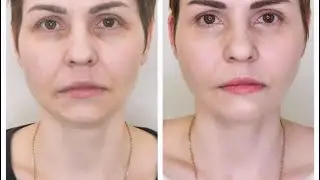 БРЫЛИ. Результат после ботулинотерапии фулфейс (с платизмой)
