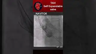TAVI Self expandable Valve 01| Navitor TAVI valve | #cardiac #tavi #cardiology #navitor #structural